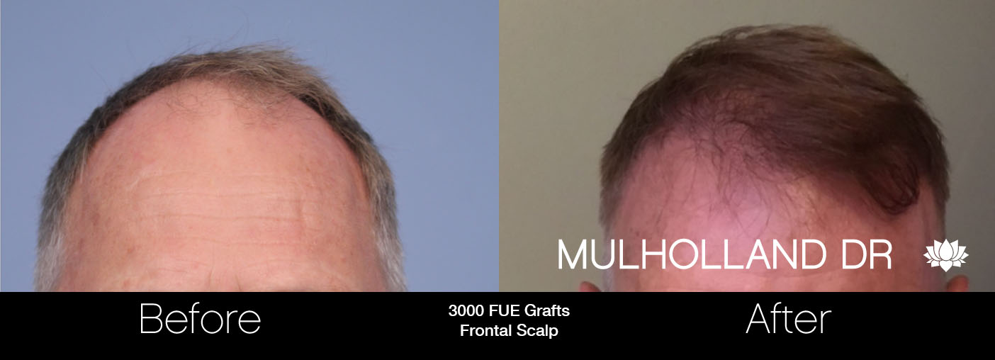 FUE Hair Male - Before and After Gallery – Photo 31