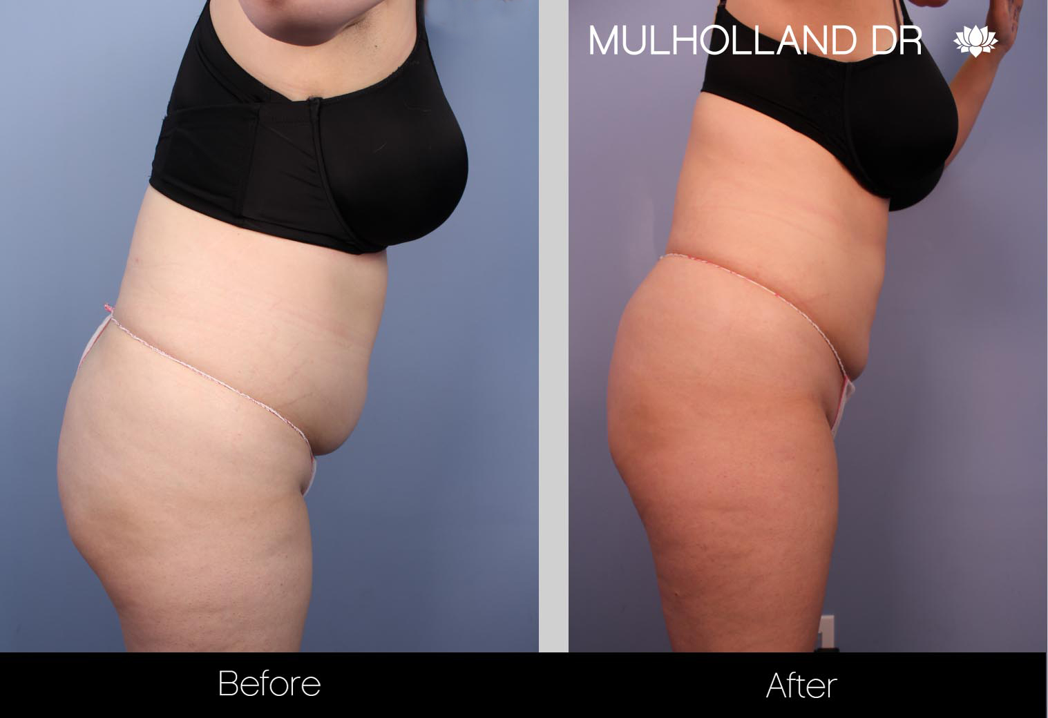 Liposuction - Before and After Gallery – Photo 35