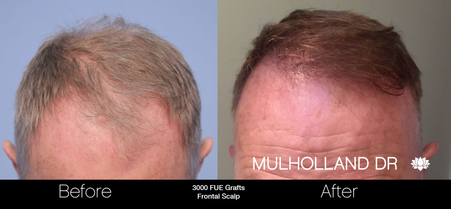 FUE Hair Male - Before and After Gallery – Photo 32