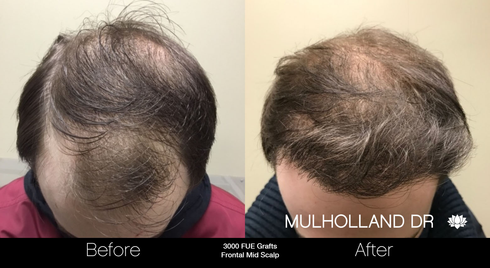 FUE Hair Male - Before and After Gallery – Photo 33