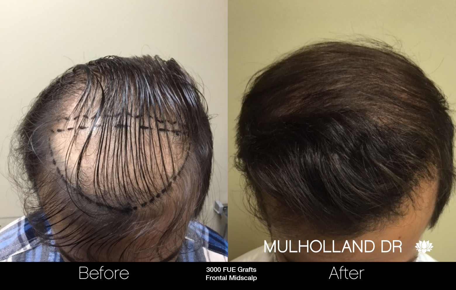 FUE Hair Male - Before and After Gallery – Photo 34