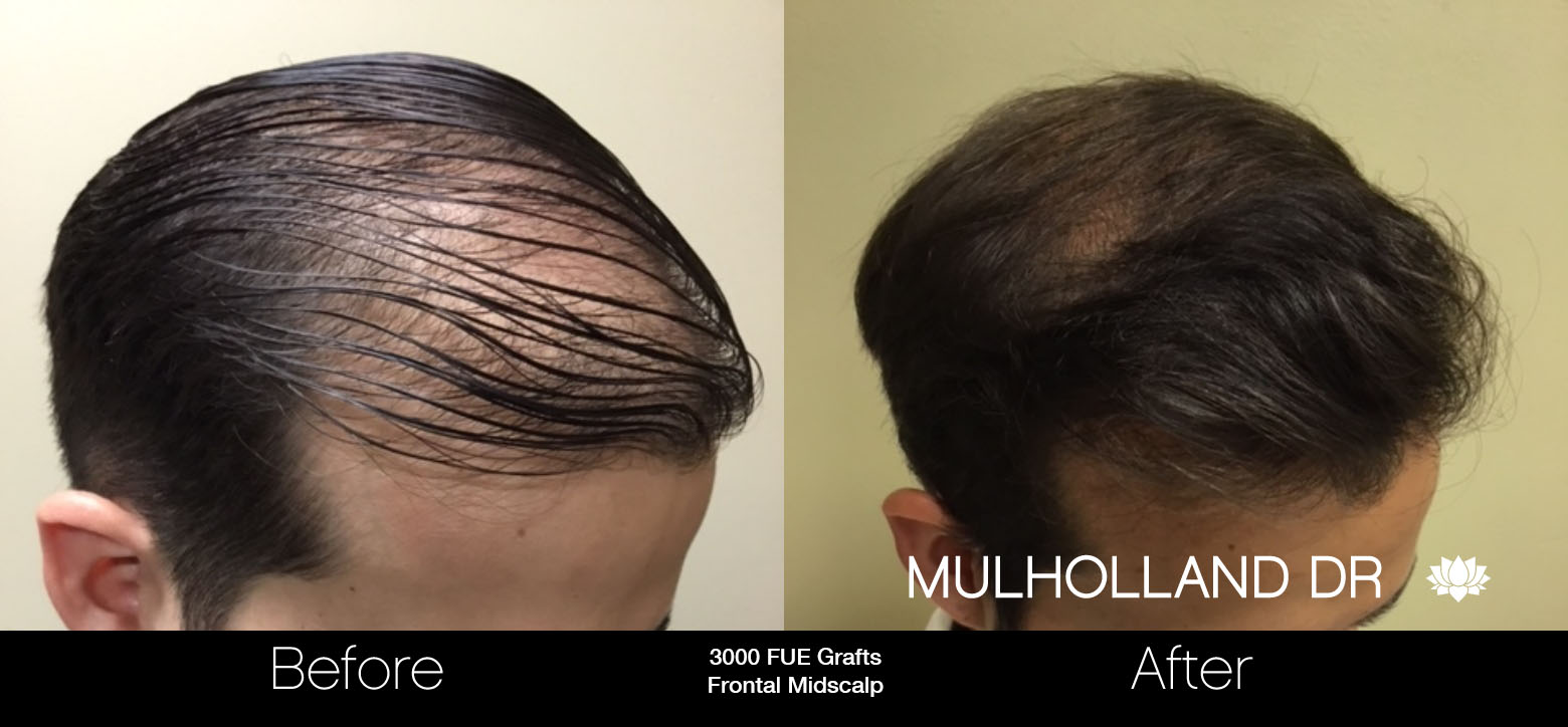 FUE Hair Male - Before and After Gallery – Photo 35
