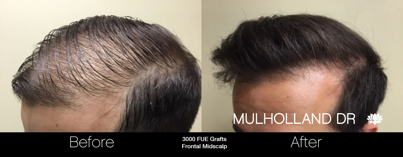 FUE Hair Male - Before and After Gallery – Photo 36