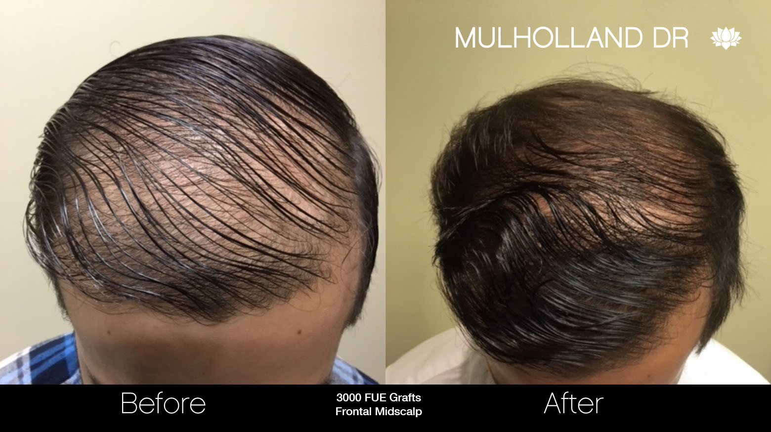 FUE Hair Male - Before and After Gallery – Photo 37