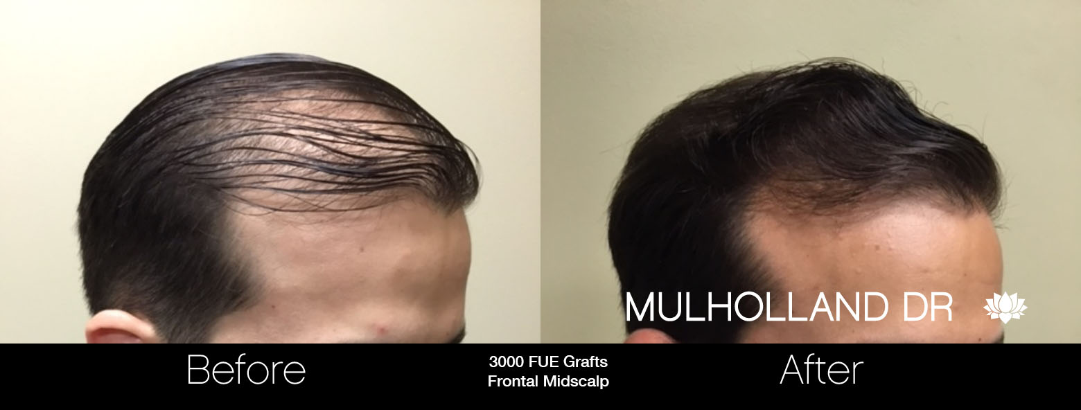 FUE Hair Male - Before and After Gallery – Photo 38