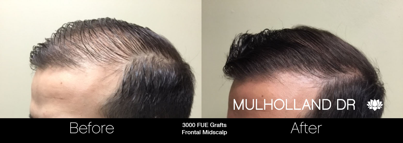 FUE Hair Male - Before and After Gallery – Photo 39