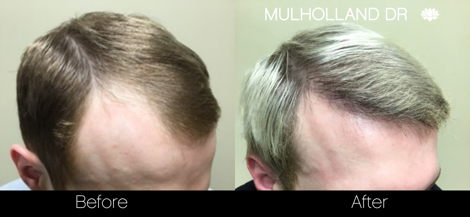 FUE Hair Male - Before and After Gallery – Photo 35