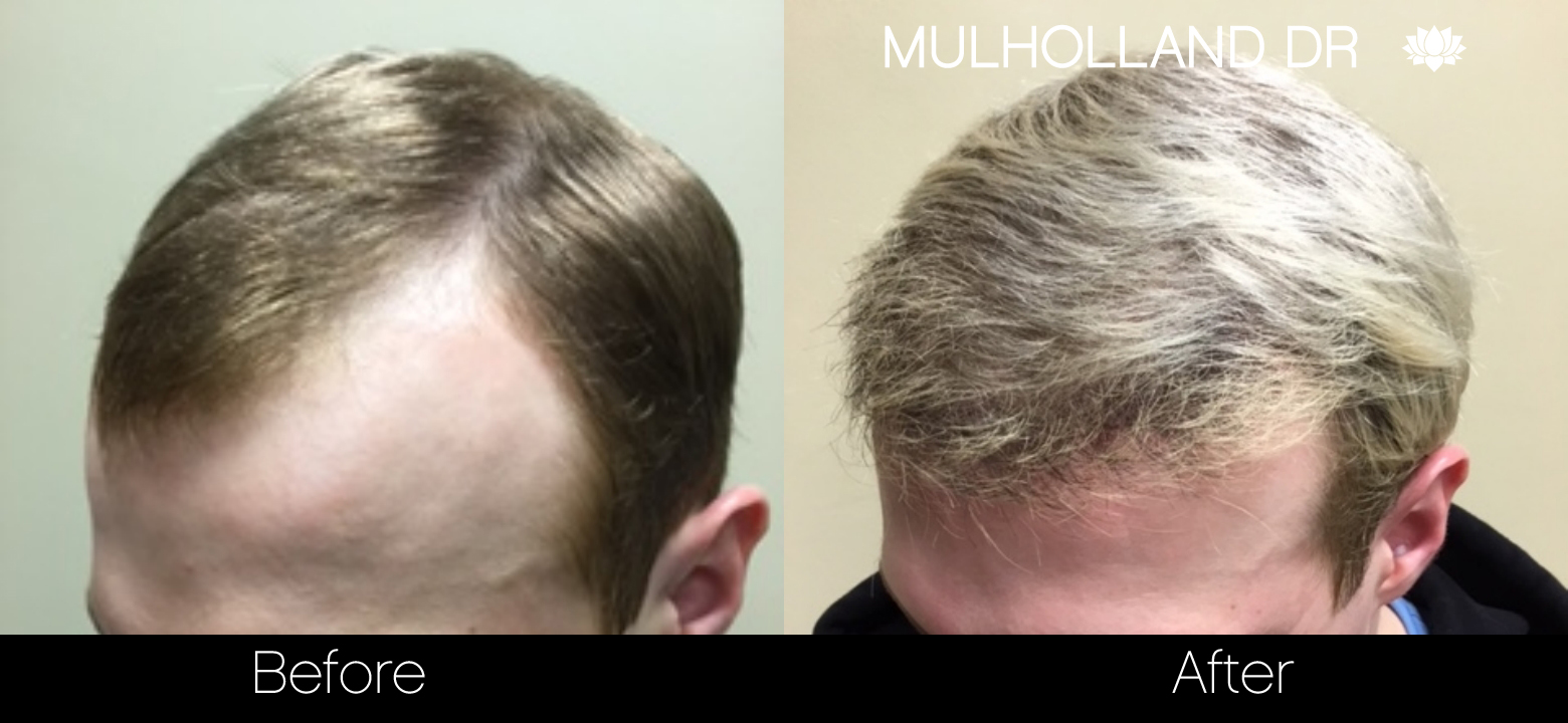 FUE Hair Male - Before and After Gallery – Photo 36