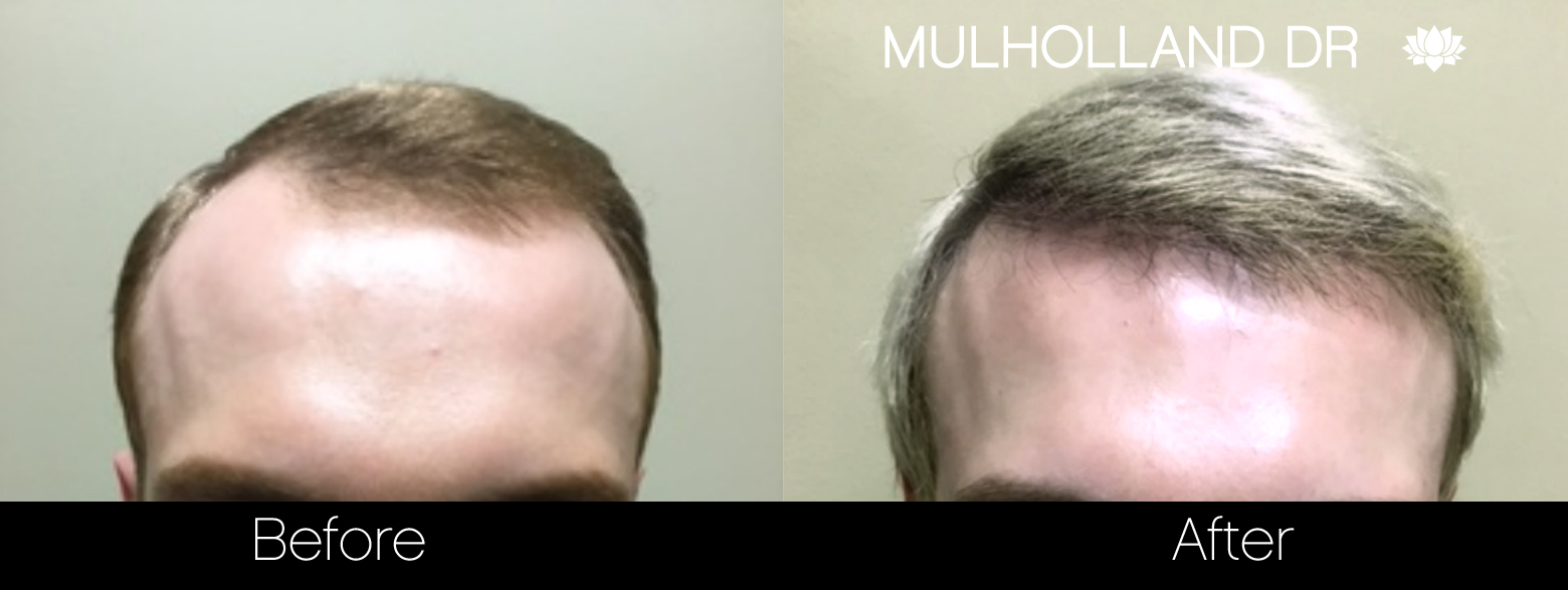 FUE Hair Male - Before and After Gallery – Photo 37