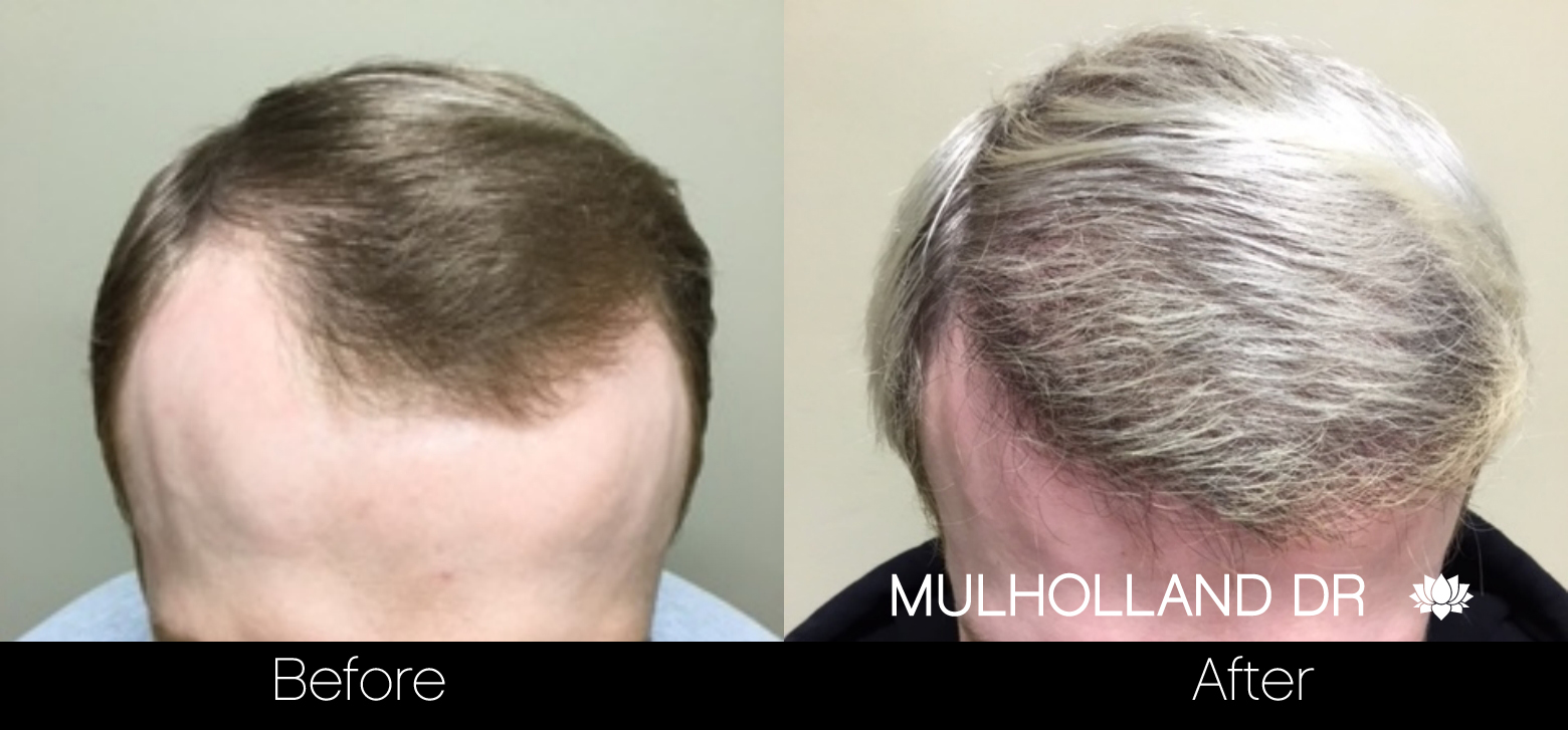 FUE Hair Male - Before and After Gallery – Photo 38