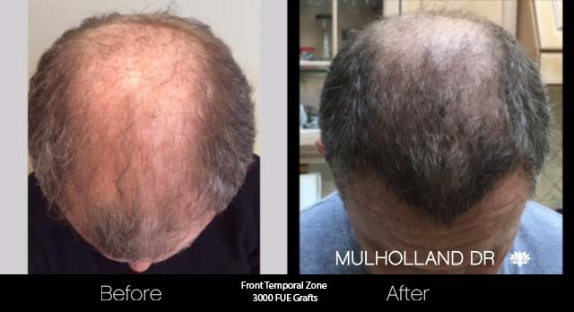 FUE Hair Male - Before and After Gallery – Photo 39