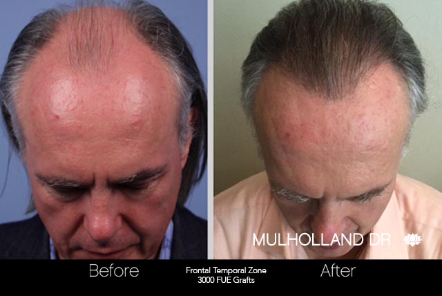 FUE Hair Male - Before and After Gallery – Photo 41