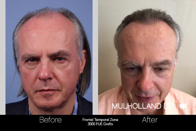 FUE Hair Male - Before and After Gallery – Photo 42