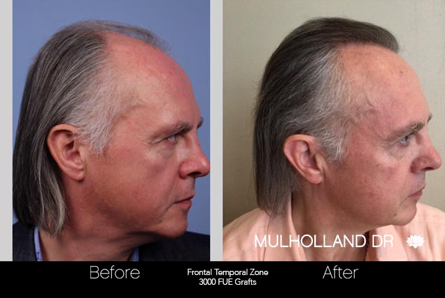 FUE Hair Male - Before and After Gallery – Photo 43