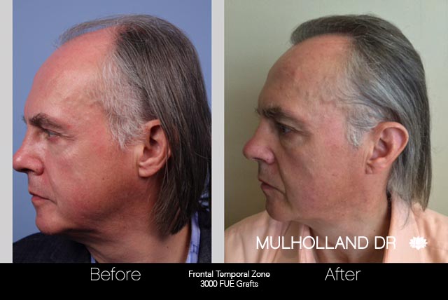 FUE Hair Male - Before and After Gallery – Photo 44