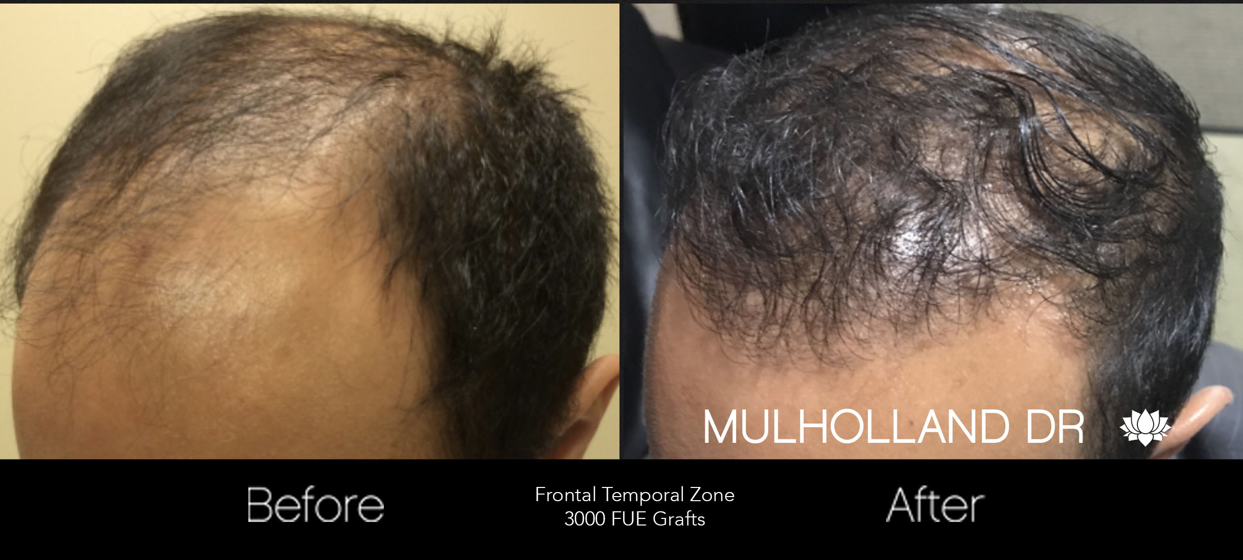 FUE Hair Male - Before and After Gallery – Photo 45