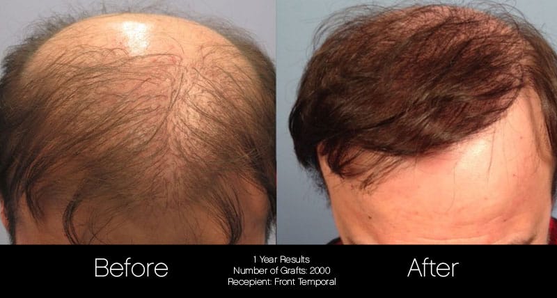 FUE Hair Male - Before and After Gallery – Photo 46