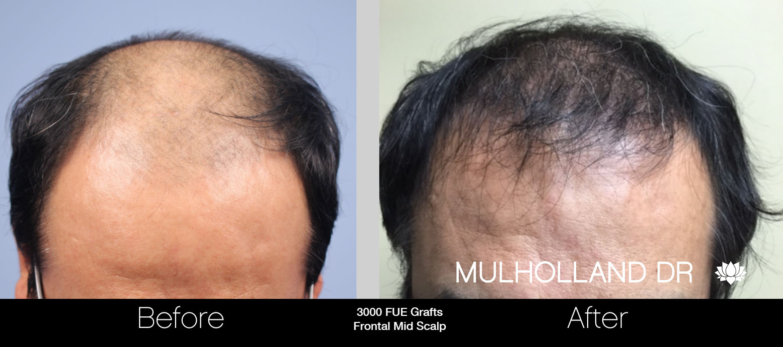FUE Hair Male - Before and After Gallery – Photo 47