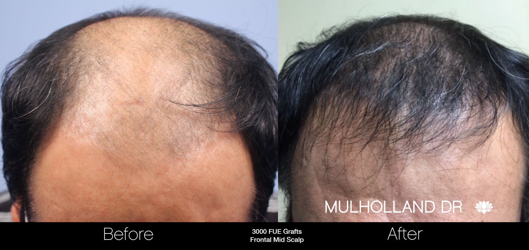 FUE Hair Male - Before and After Gallery – Photo 48