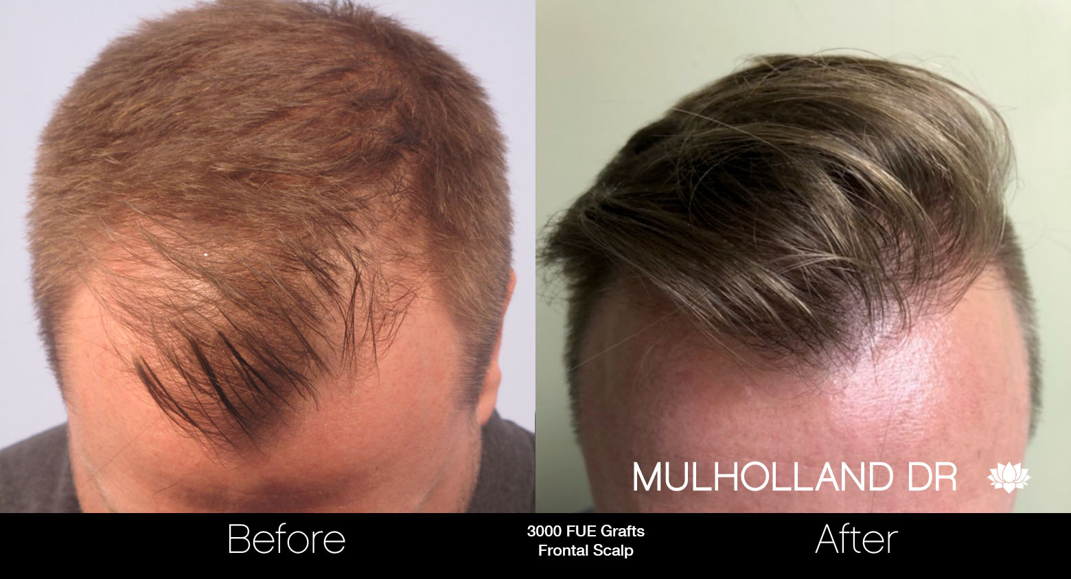 FUE Hair Male - Before and After Gallery – Photo 49