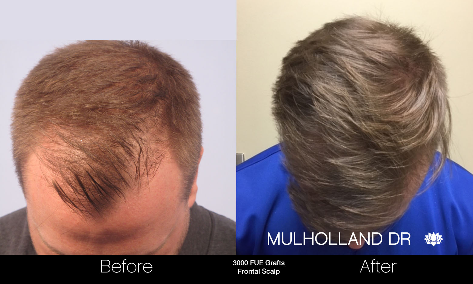 FUE Hair Male - Before and After Gallery – Photo 51