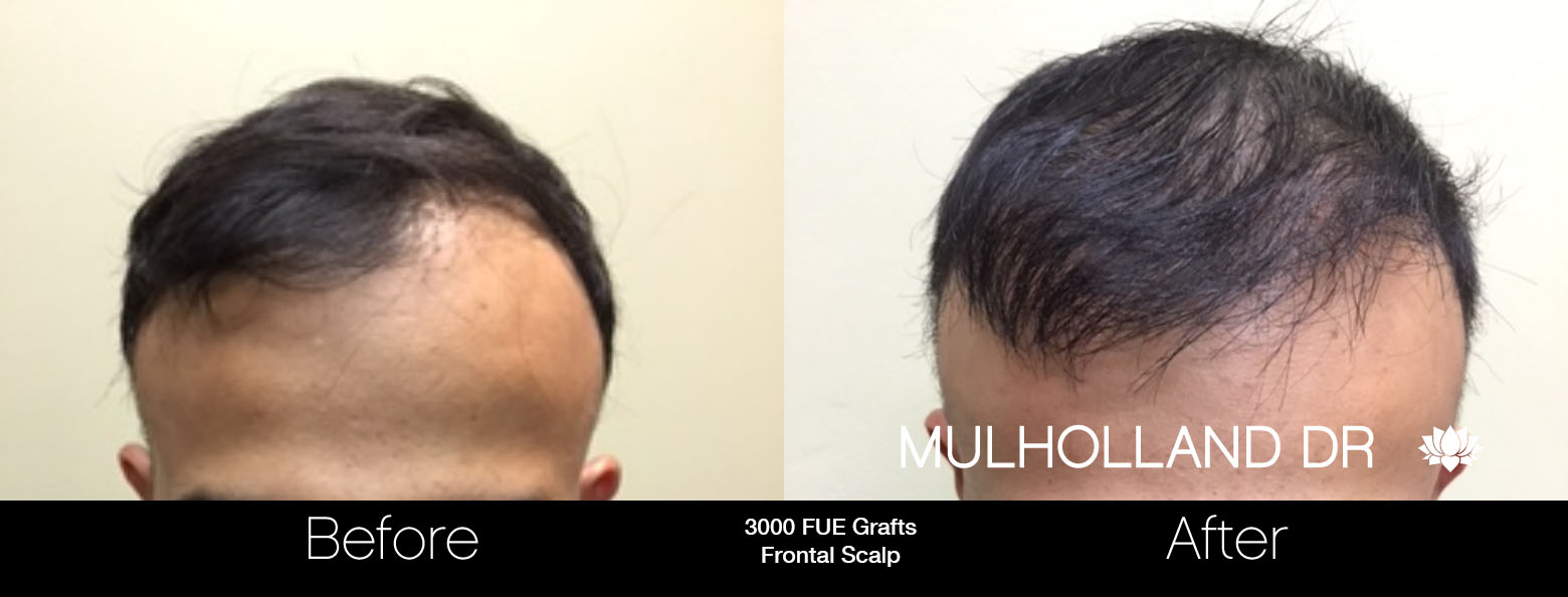 FUE Hair Male - Before and After Gallery – Photo 52