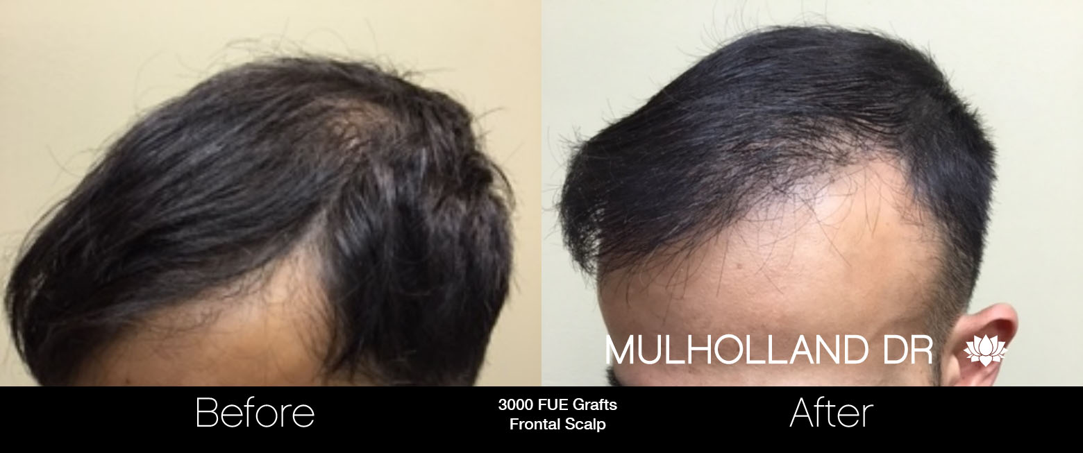 FUE Hair Male - Before and After Gallery – Photo 53