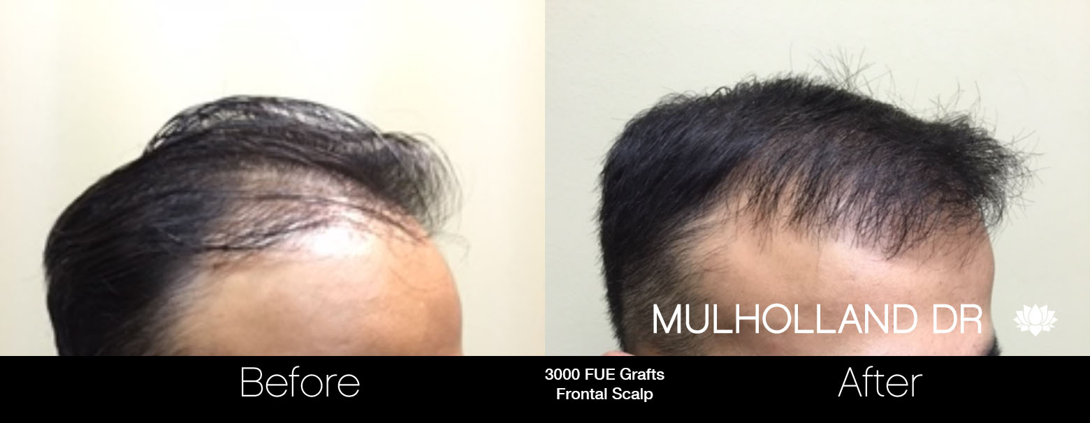 FUE Hair Male - Before and After Gallery – Photo 54