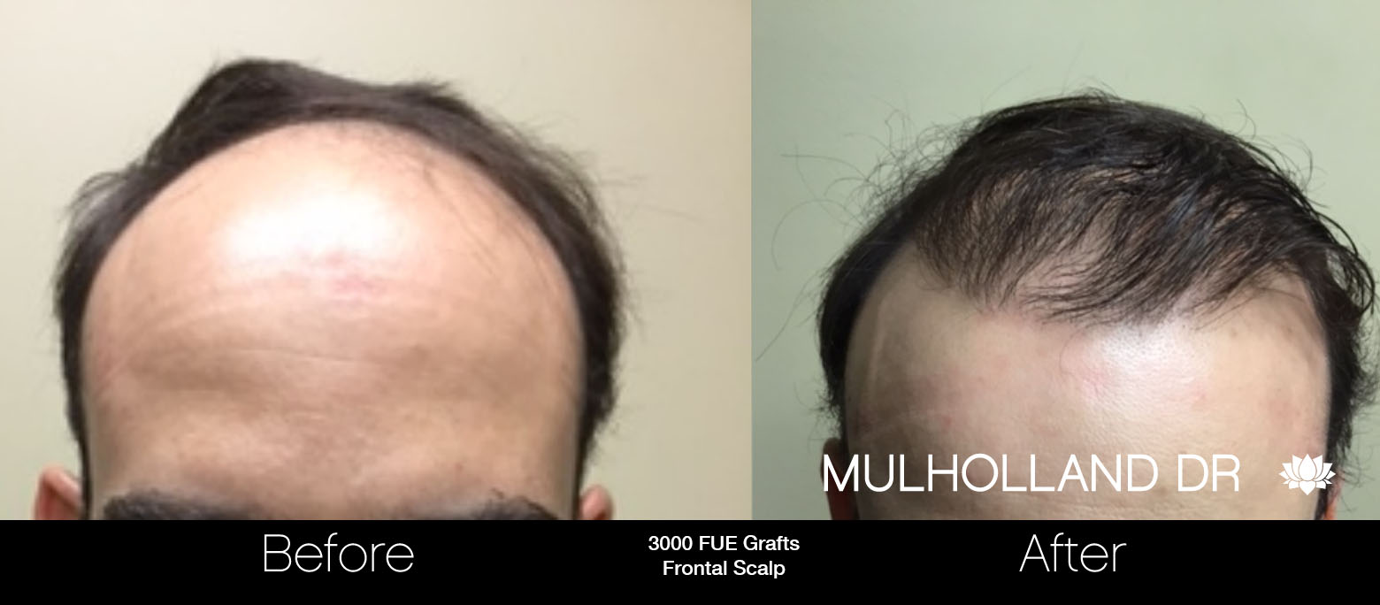 FUE Hair Male - Before and After Gallery – Photo 55