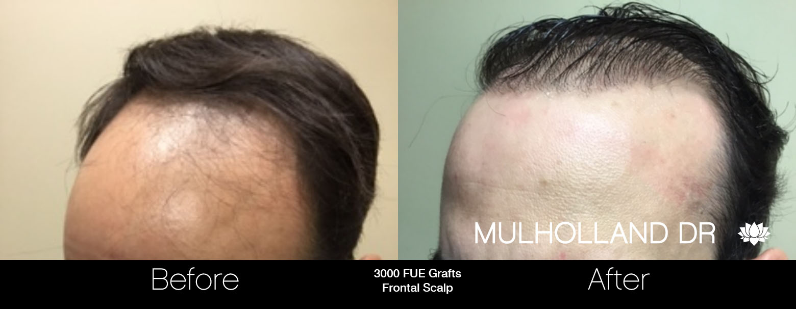 FUE Hair Male - Before and After Gallery – Photo 56