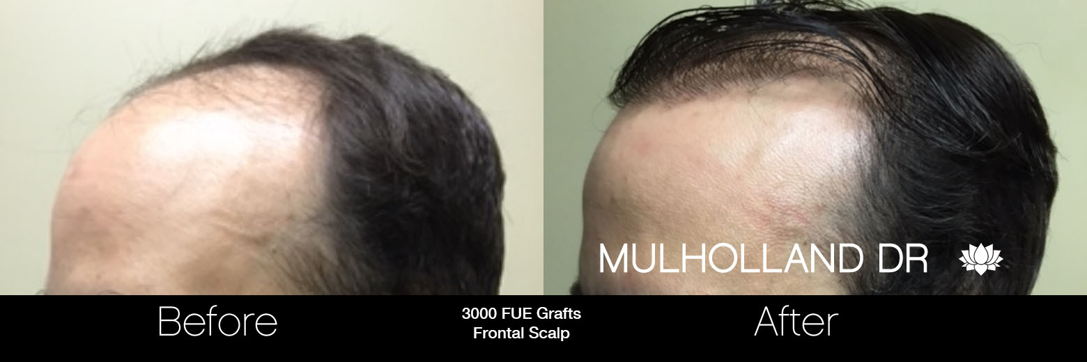 FUE Hair Male - Before and After Gallery – Photo 57