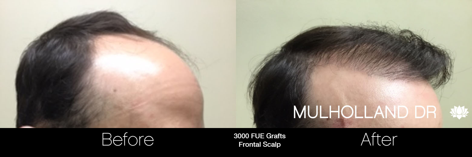 FUE Hair Male - Before and After Gallery – Photo 58