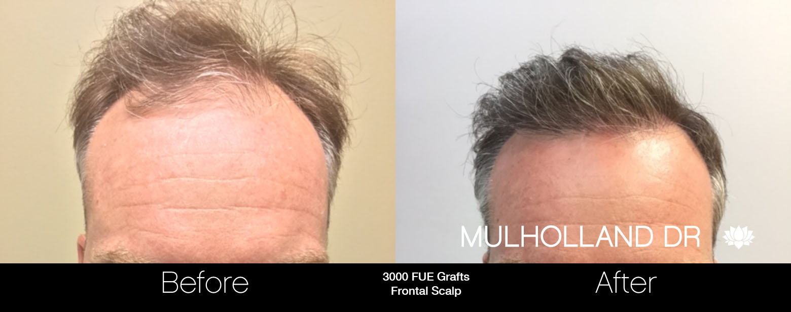 FUE Hair Male - Before and After Gallery – Photo 59