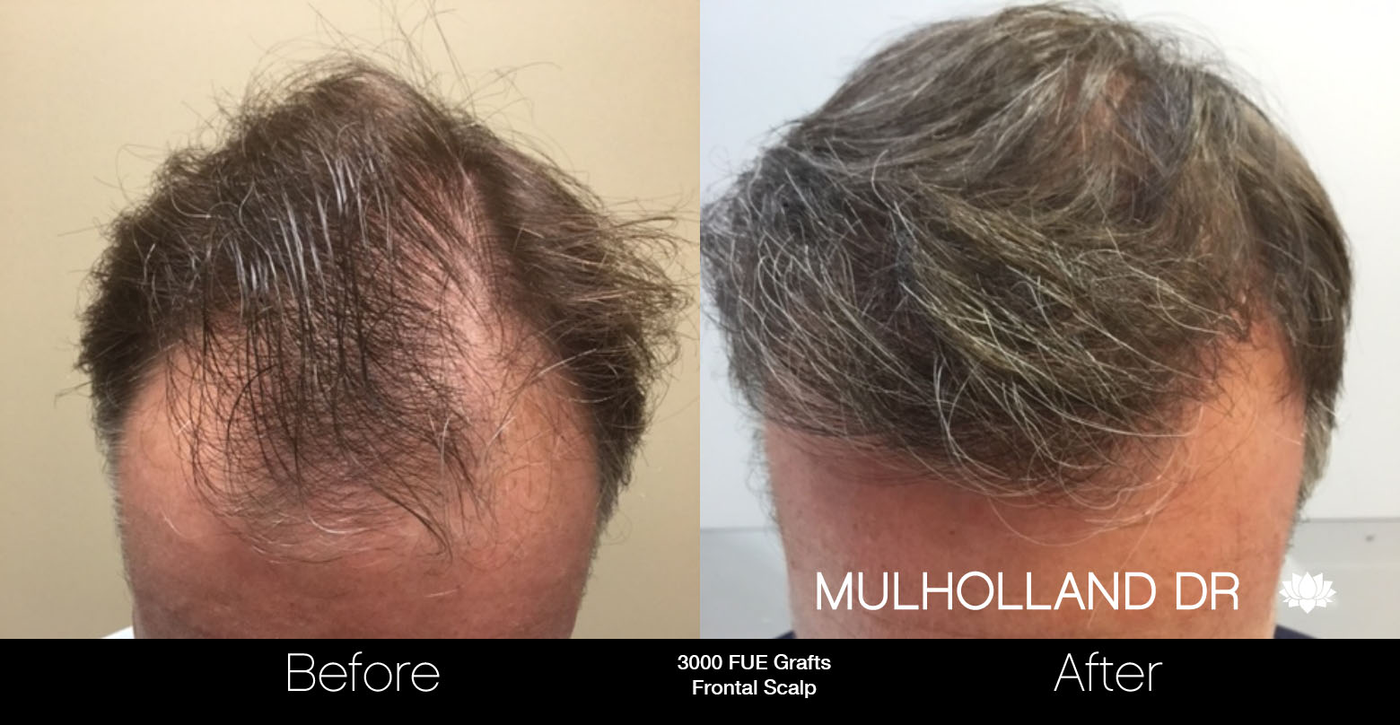 FUE Hair Male - Before and After Gallery – Photo 60