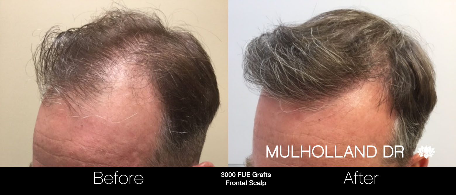 FUE Hair Male - Before and After Gallery – Photo 61