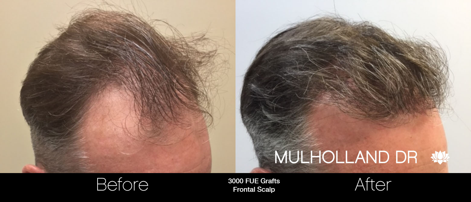 FUE Hair Male - Before and After Gallery – Photo 62