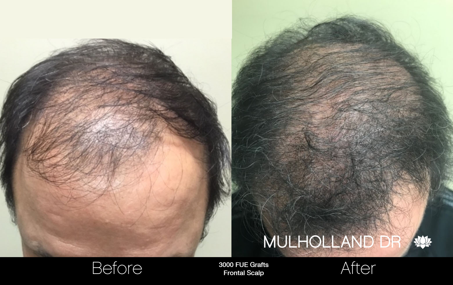 Ottawa FUE Hair Transplant | SpaMedica Ottawa FUE Hair Transplant | SpaMedica