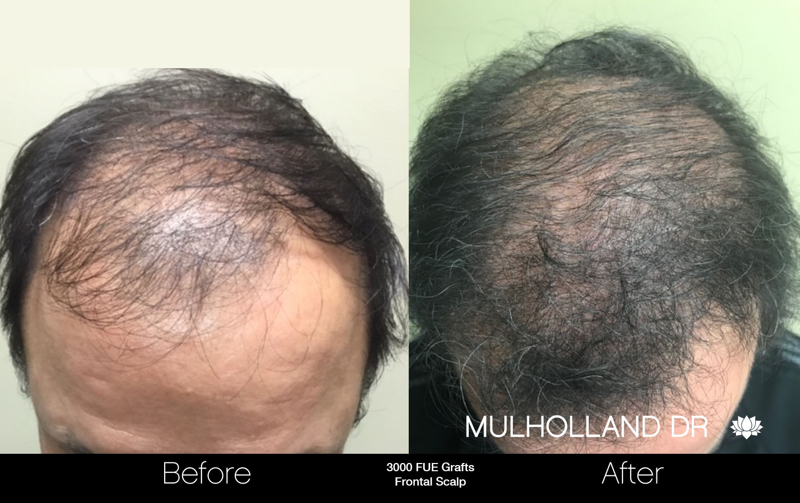 FUE Hair Male - Before and After Gallery – Photo 63