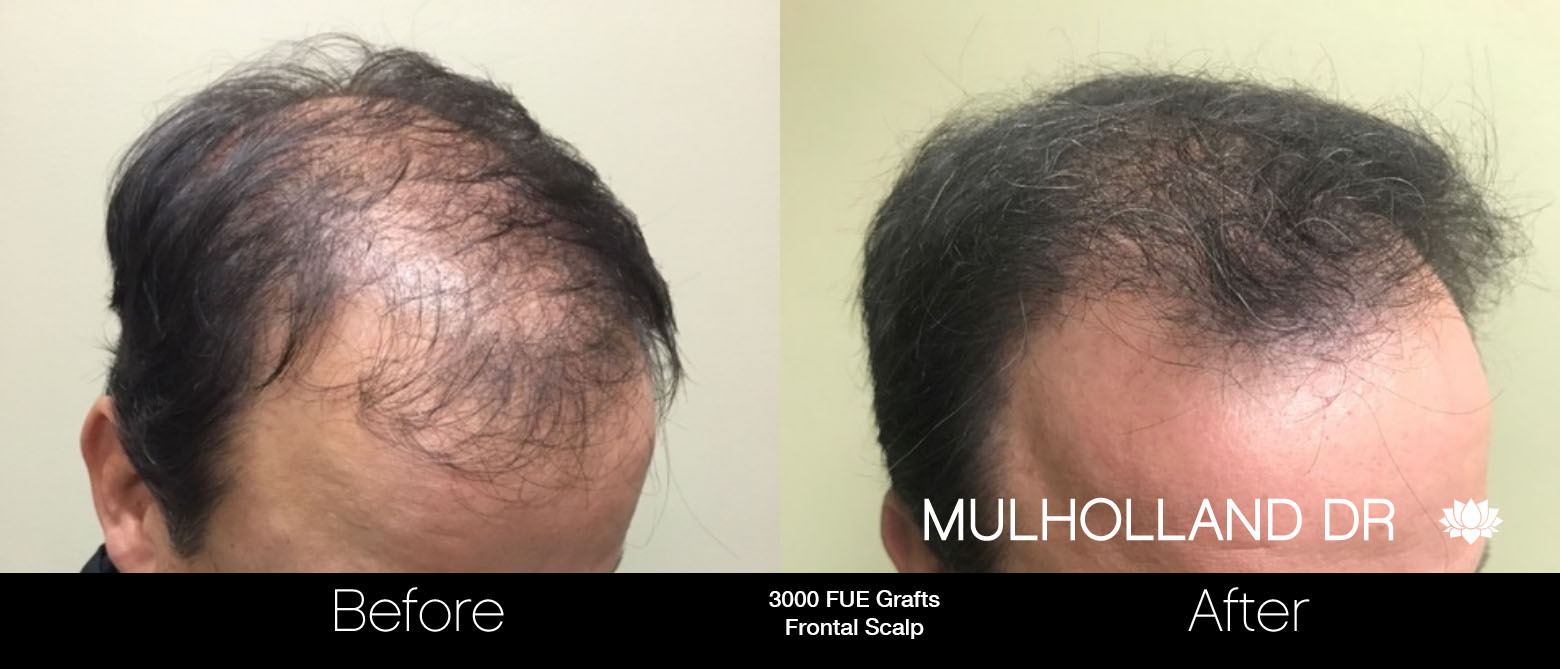 FUE Hair Male - Before and After Gallery – Photo 64
