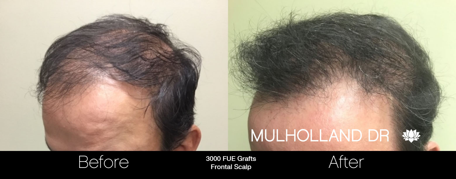 FUE Hair Male - Before and After Gallery – Photo 65