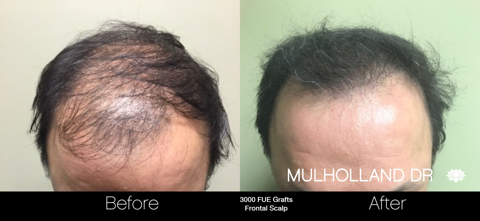 FUE Hair Male - Before and After Gallery – Photo 66