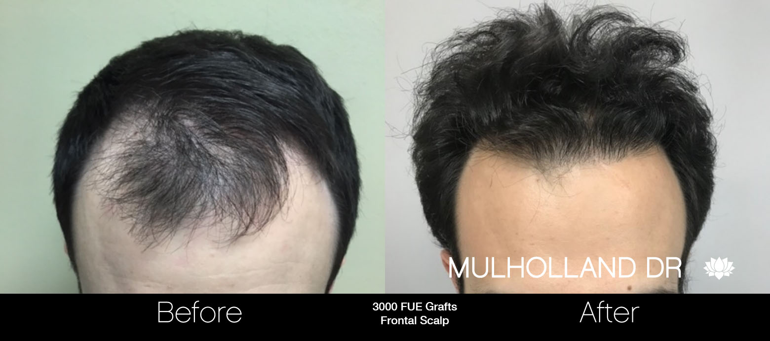 FUE Hair Male - Before and After Gallery – Photo 67