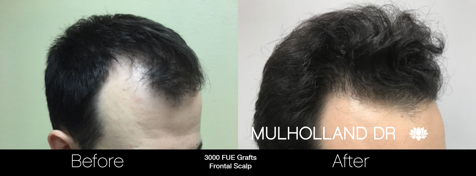 FUE Hair Male - Before and After Gallery – Photo 68