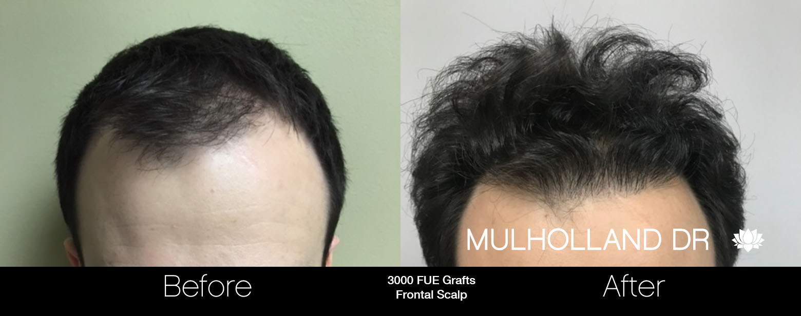 FUE Hair Male - Before and After Gallery – Photo 69