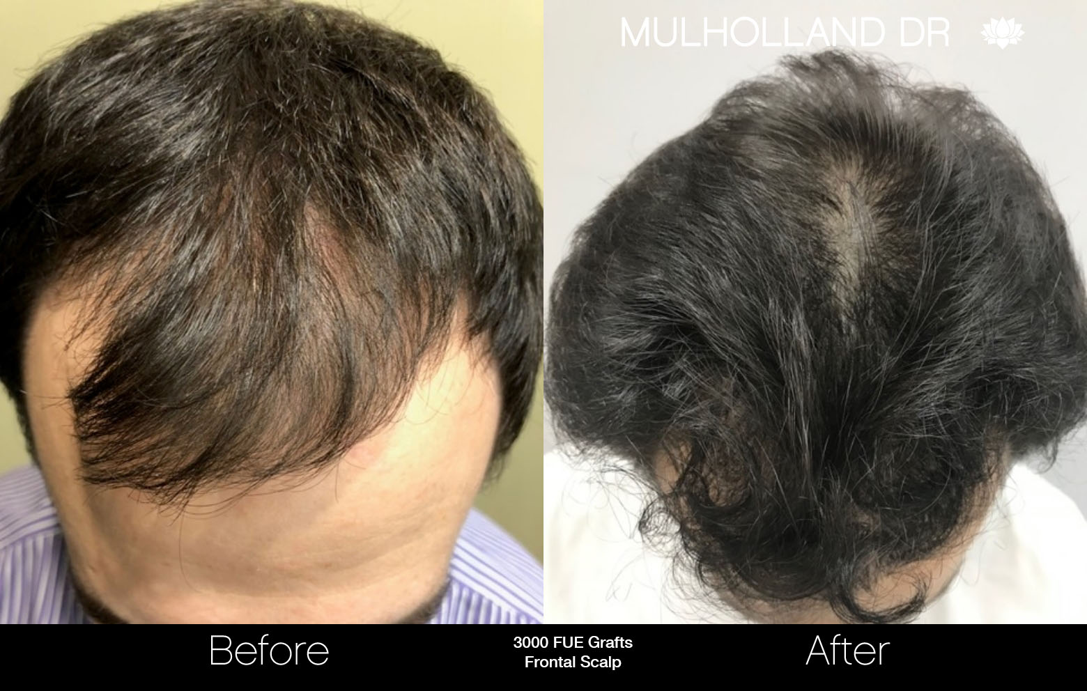 FUE Hair Male - Before and After Gallery – Photo 70