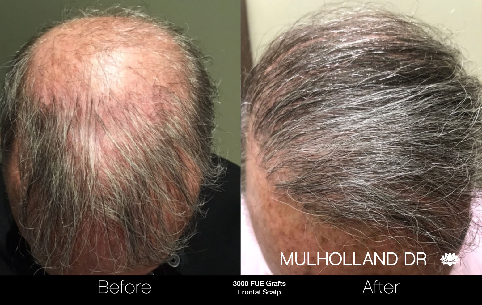 FUE Hair Male - Before and After Gallery – Photo 71