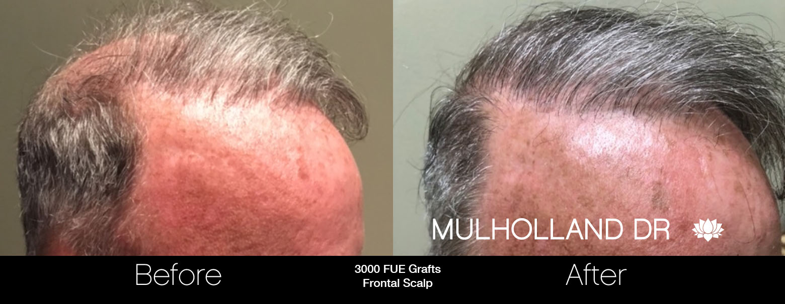 FUE Hair Male - Before and After Gallery – Photo 72