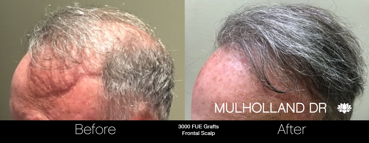 FUE Hair Male - Before and After Gallery – Photo 73