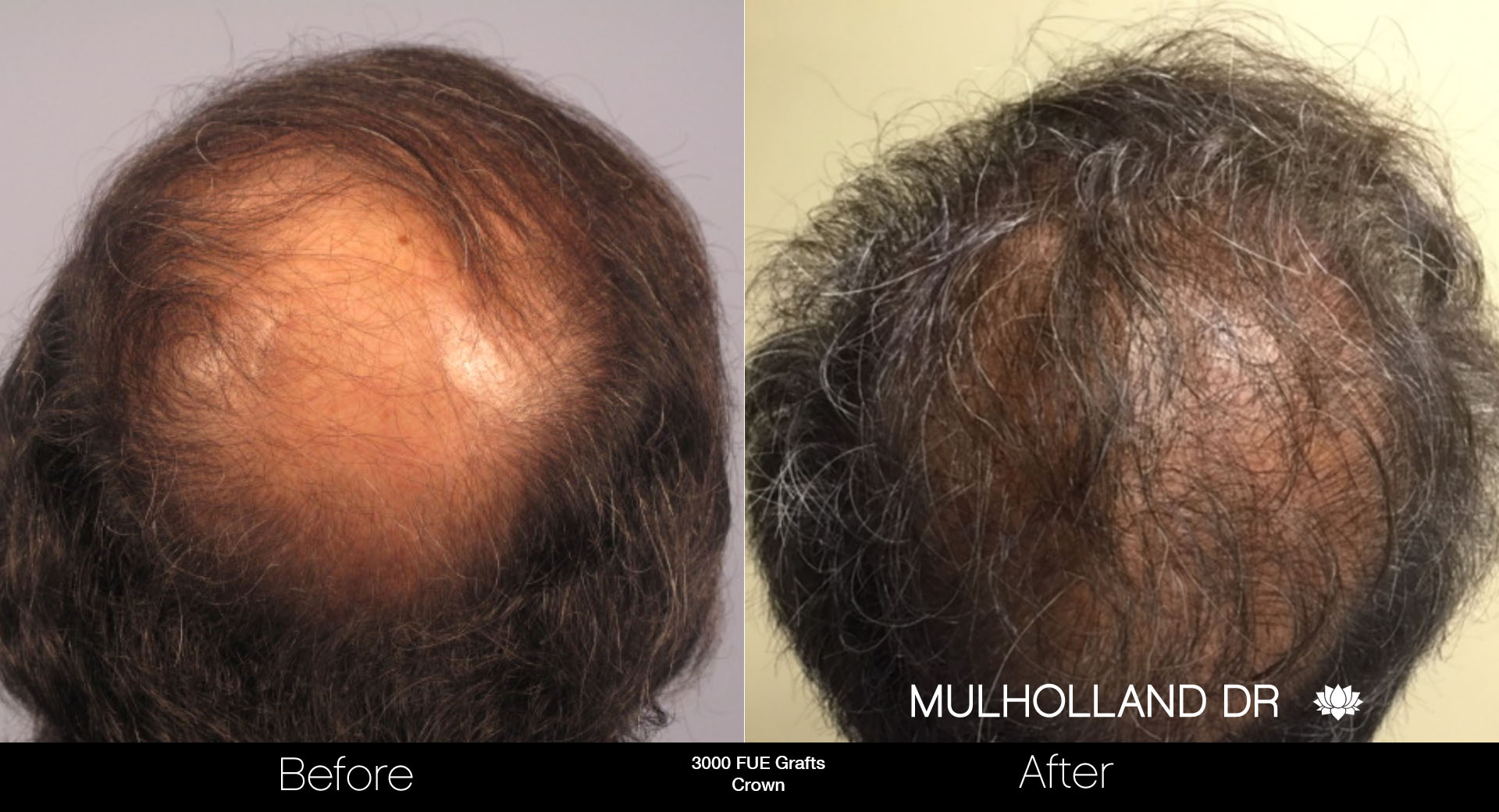 FUE Hair Male - Before and After Gallery – Photo 74