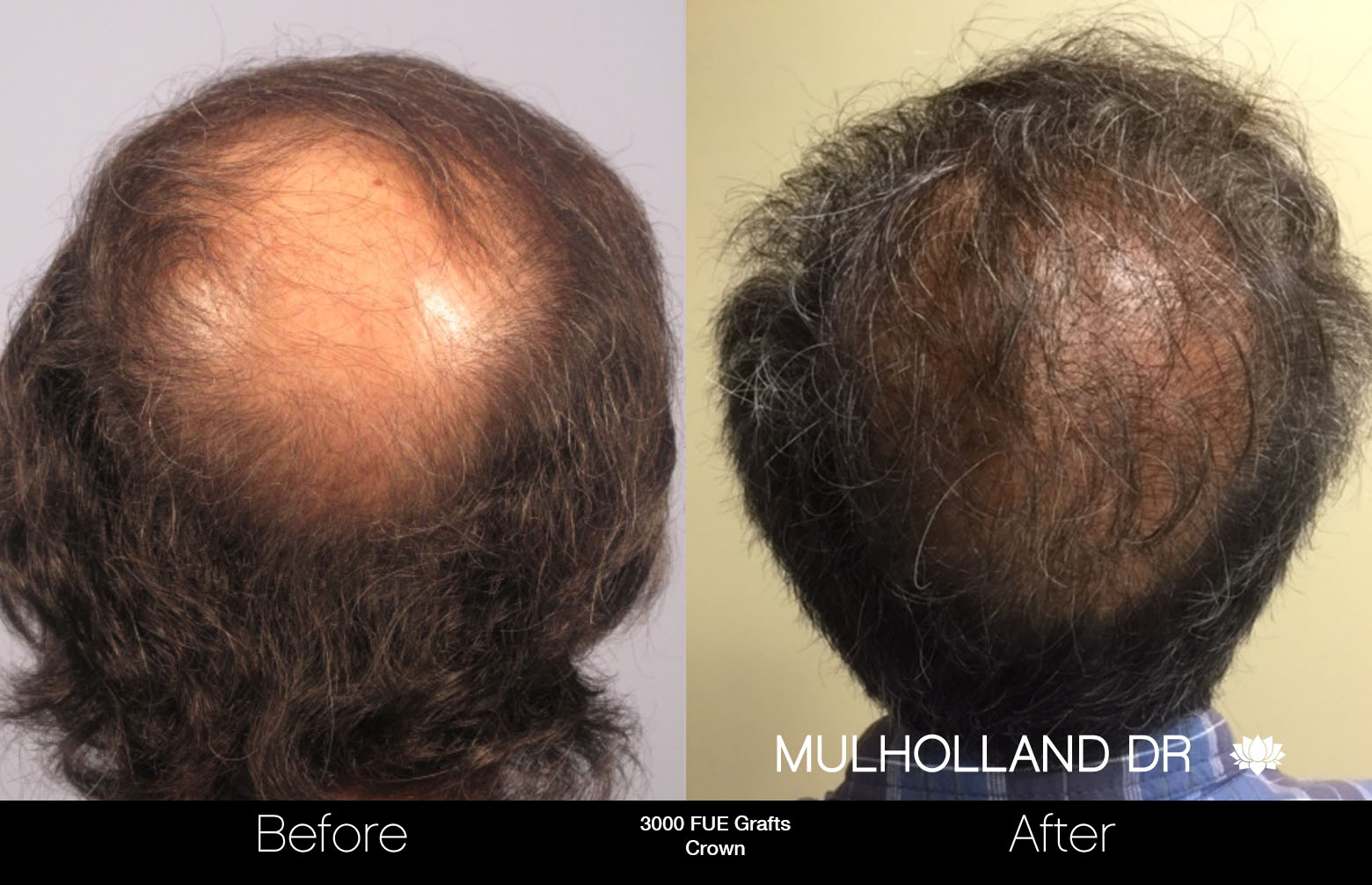FUE Hair Male - Before and After Gallery – Photo 75